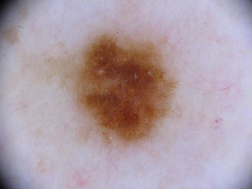 Nevus Image